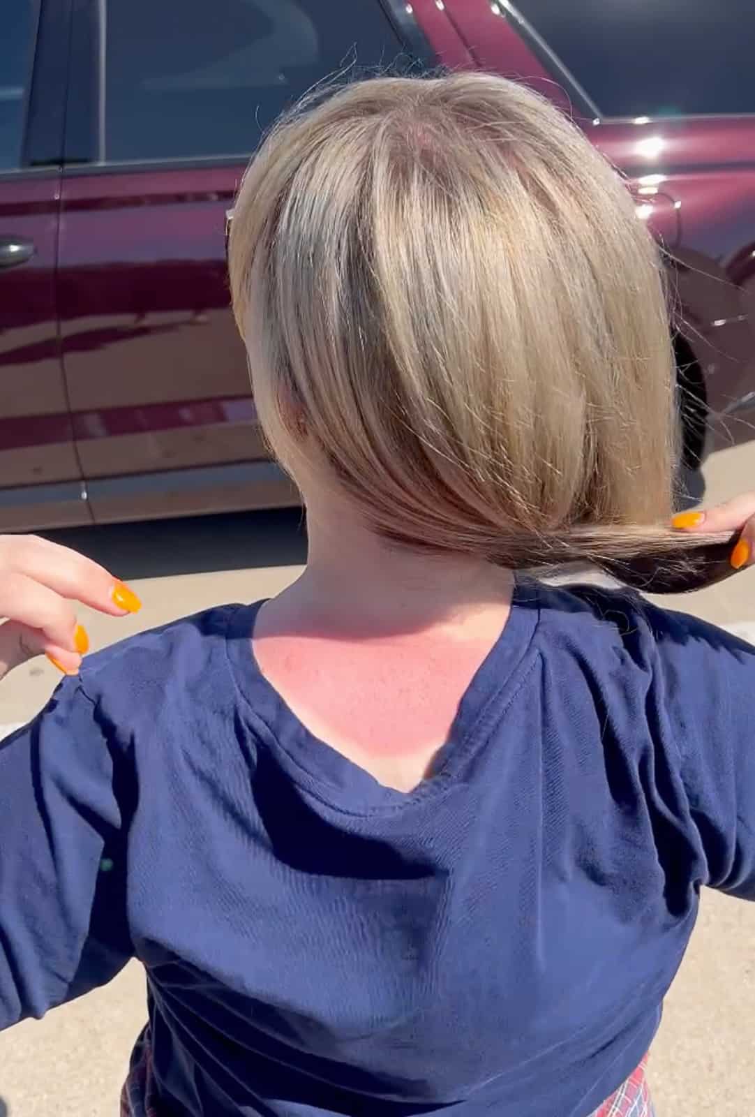 Sunburn on Woman