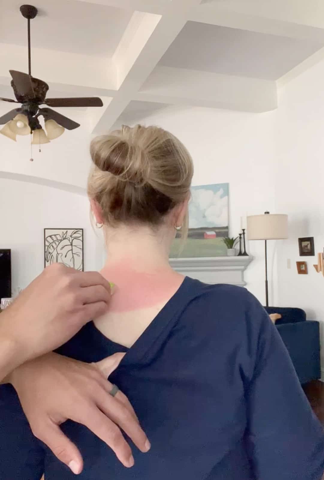 Treating A Sunburn with Aloe Vera Plant